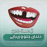 آنچه باید در مورد از دست دادن دندانهای جلو بدانید ؟