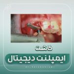 تاثیر زیبایی بر کاشت ایمپلنت دیجیتال -2