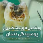 ویتامین D و پیشگیری از پوسیدگی دندان