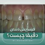 فرسایش دندان (Erosion) دقیقاً چیست؟