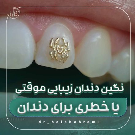 چسباندن یک نگین دندان معمولاً چقدر زمان میبرد؟