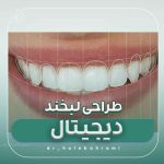 طراحی لبخند دیجیتال (DSD)
