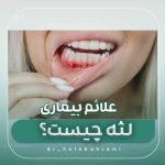علائم بیماری لثه (ژنژیویت و پریودنتیت) چیست و چگونه درمان میشود؟