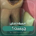 آبسه دندان چیست و چه درمان فوری برای آن وجود دارد؟