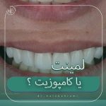 لمینت بهتر است یا کامپوزیت ؟