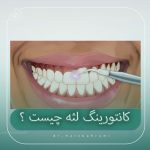 کانتورینگ لثه چیست ؟